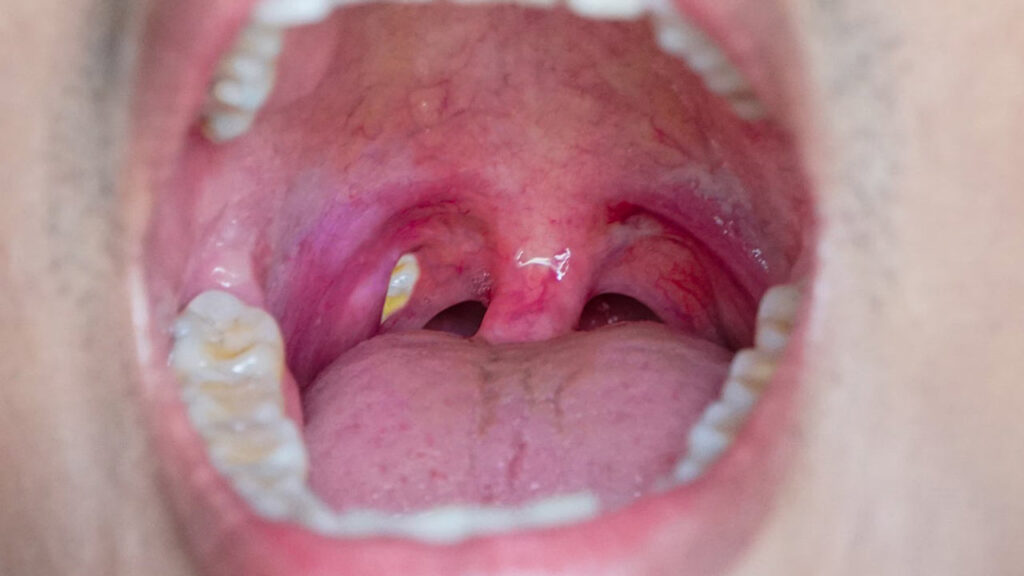 گیر کردن مواد غذایی در لوزه