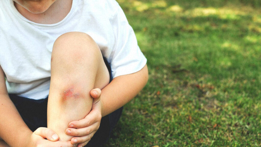 علائم کوفتگی بدن در اثر ضربه