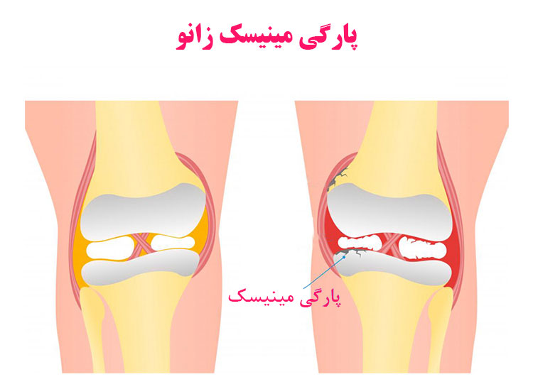 علائم پارگی مینیسک زانو