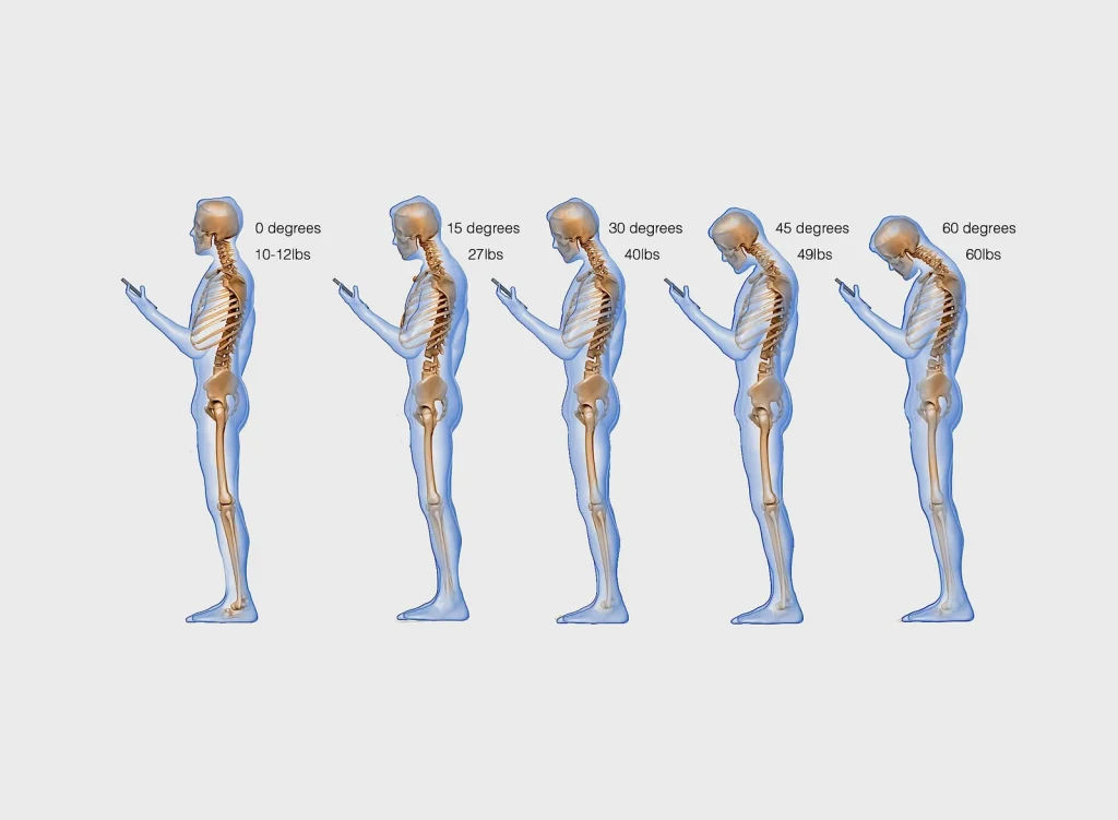 انواع کیفوز یا قوز کمر