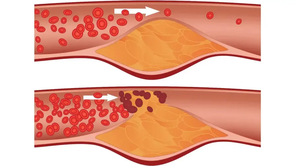 علت انسداد رگ های خونی