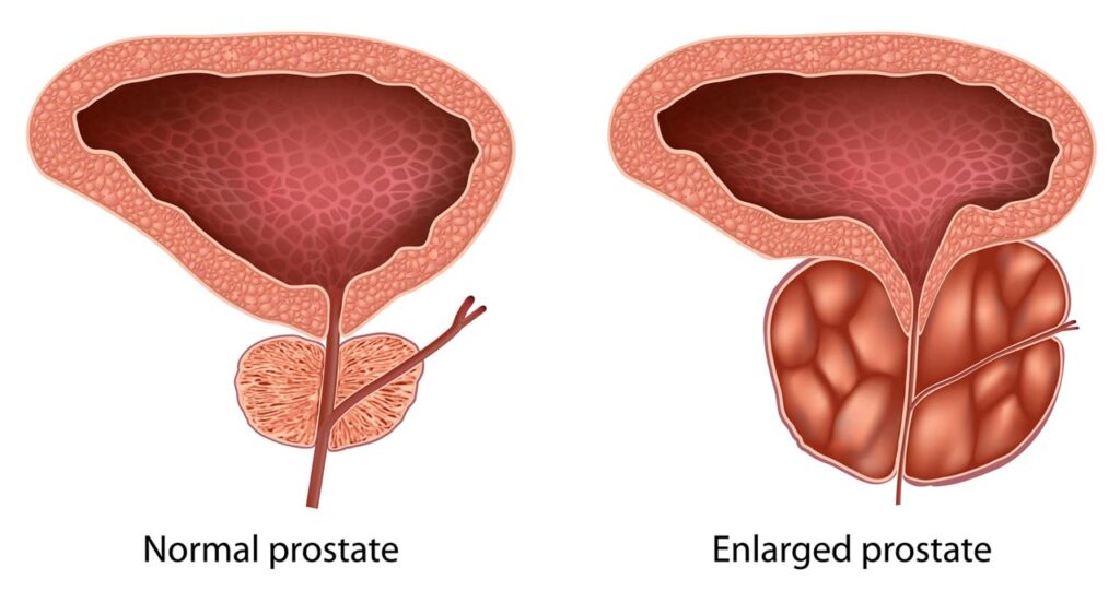 تفاوت پروستات سالم با التهاب پروستات