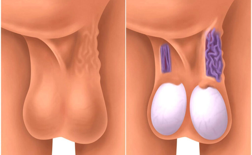 تفاوت رگ واریکوسل بیضه با رگ سالم