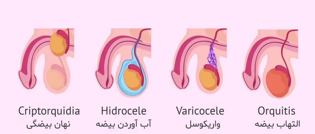 انواع مشکلات بیضه